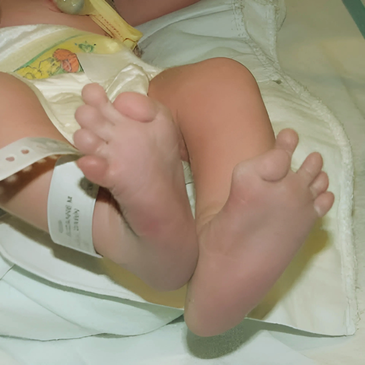Pés de um bebê com os polegares virados para dentro, um dos primeiros sintomas da FOP